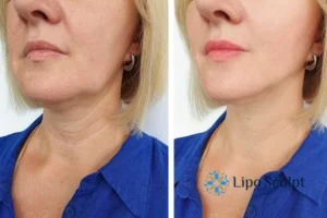 Double chin before and after Hi-Fu treatment 4 Book your double chin treatment Hampshire today! We are here to help!