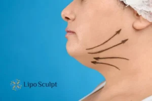 Double chin before and after Hi-Fu treatment 3 Boost your confidence with a Double chin treatment Hampshire