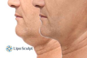 Double chin before and after Hi-Fu treatment 2 Double chin treatment Hampshire from Lipo Sculpt - feel more confident today!