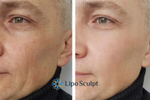 How to Fight Aging Symptoms 3 Fight Aging Symptoms Hampshire With HIFU and Morpheus8 Today!