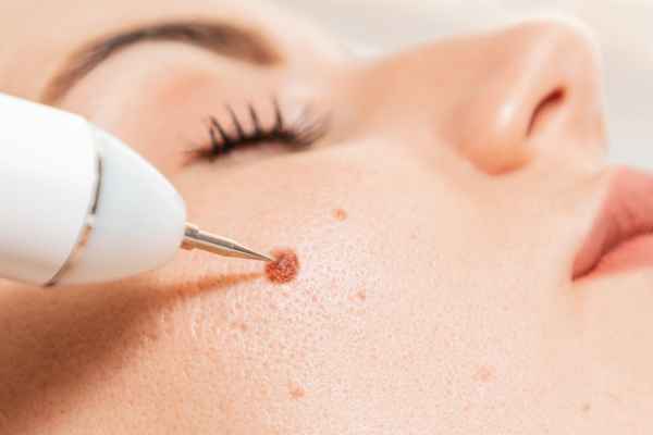 CryoPen: 5 Skin Concerns It May Be Used to Treat 3 What actually happens during a CryoPen treatment Hampshire?