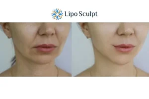 Explaining Total Skin Tightening Treatment And What It Can Do For You 2 Do you want to boost your self confidence? Give Morpheus8 Hampshire a try today!
