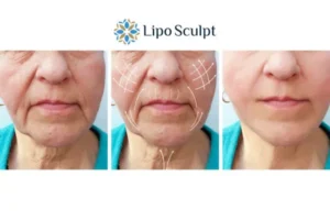 Explaining Total Skin Tightening Treatment And What It Can Do For You 3 Boost your confidence with Morpheus8 Hampshire call our team today!