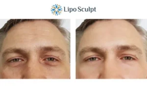 Explaining Total Skin Tightening Treatment And What It Can Do For You 6 Morpheus8 Hampshire book in today to find out more!