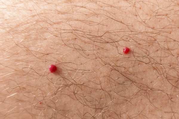 CryoPen: 5 Skin Concerns It May Be Used to Treat 2 cherry angioma removal Hampshire