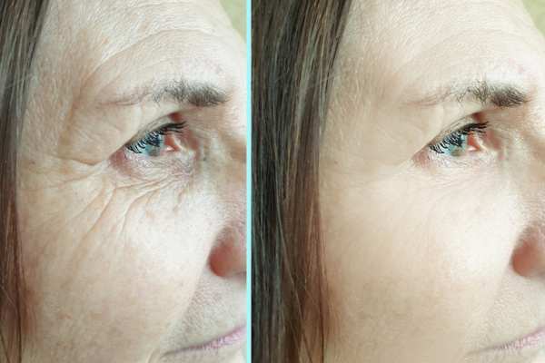 Why Do People Choose HIFU for a Non-Surgical Facelift? 4 How long can HIFU results last Hampshire?