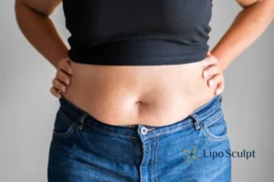 Bidding Farewell to Muffin Tops with Aqualyx Fat Injections 2 Do you wish you could reduce your muffin top Hampshire With Aqualy fat dissolving injections you can!