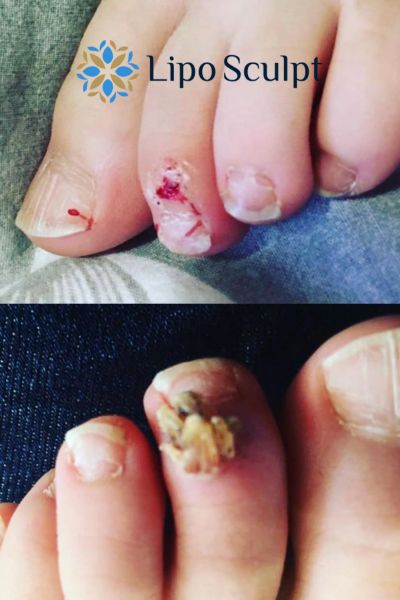 Wart removal customer results from Lipo Sculpt Hampshire