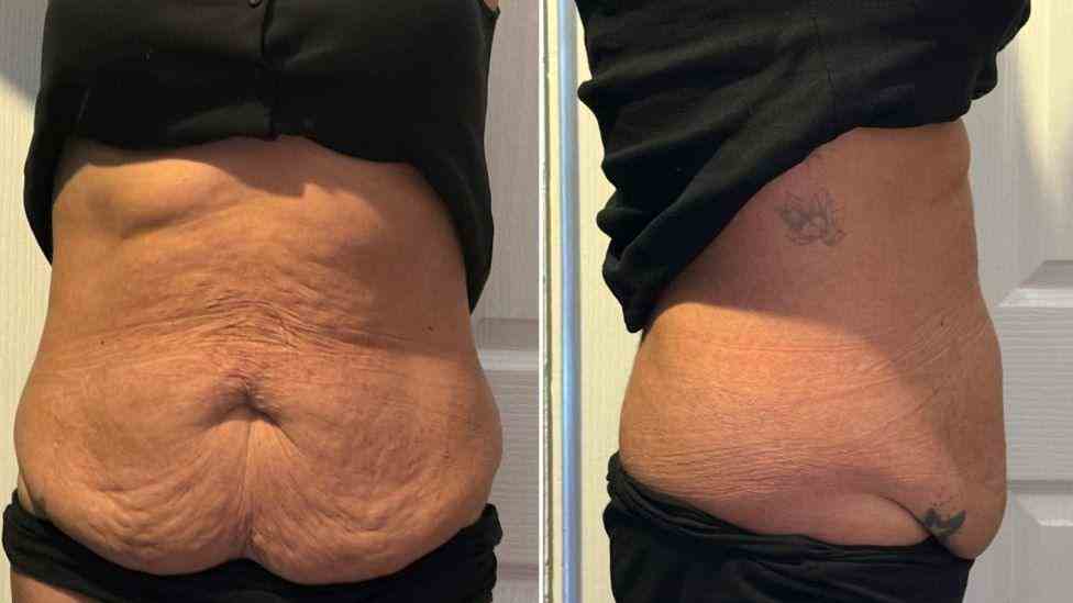 Lost the Weight but Not the Loose Skin? What You Should Know 1 Is It Definitely Loose Skin Hampshire?