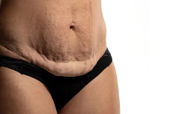 Lost the Weight but Not the Loose Skin? 1 image of womans stomach after weight loss showing loose skin Hampshire